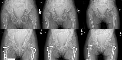 Abduction pillow after clearance total hip replacement